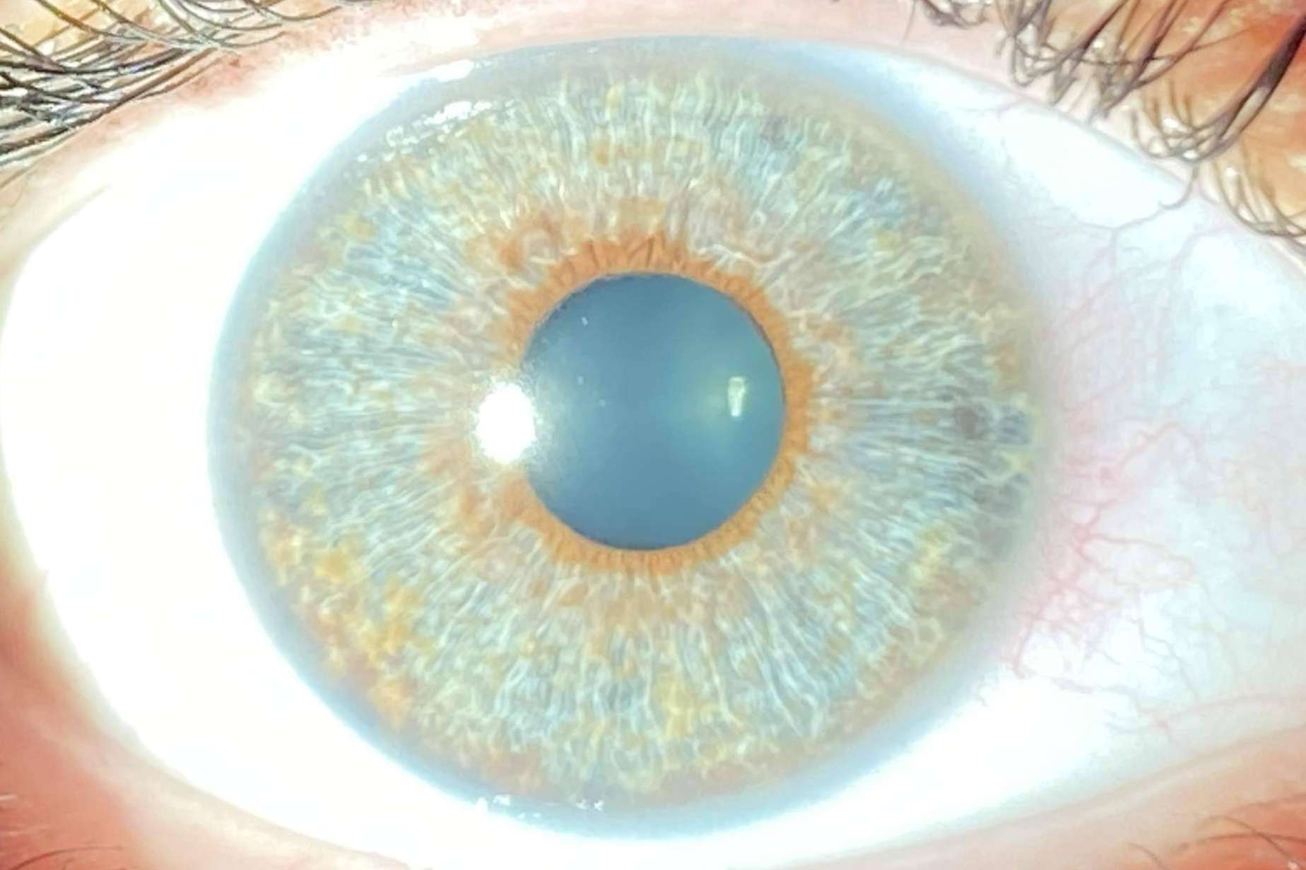 Clínica Eyecos y los avances en las operaciones de cambio de color de ojos con láser
