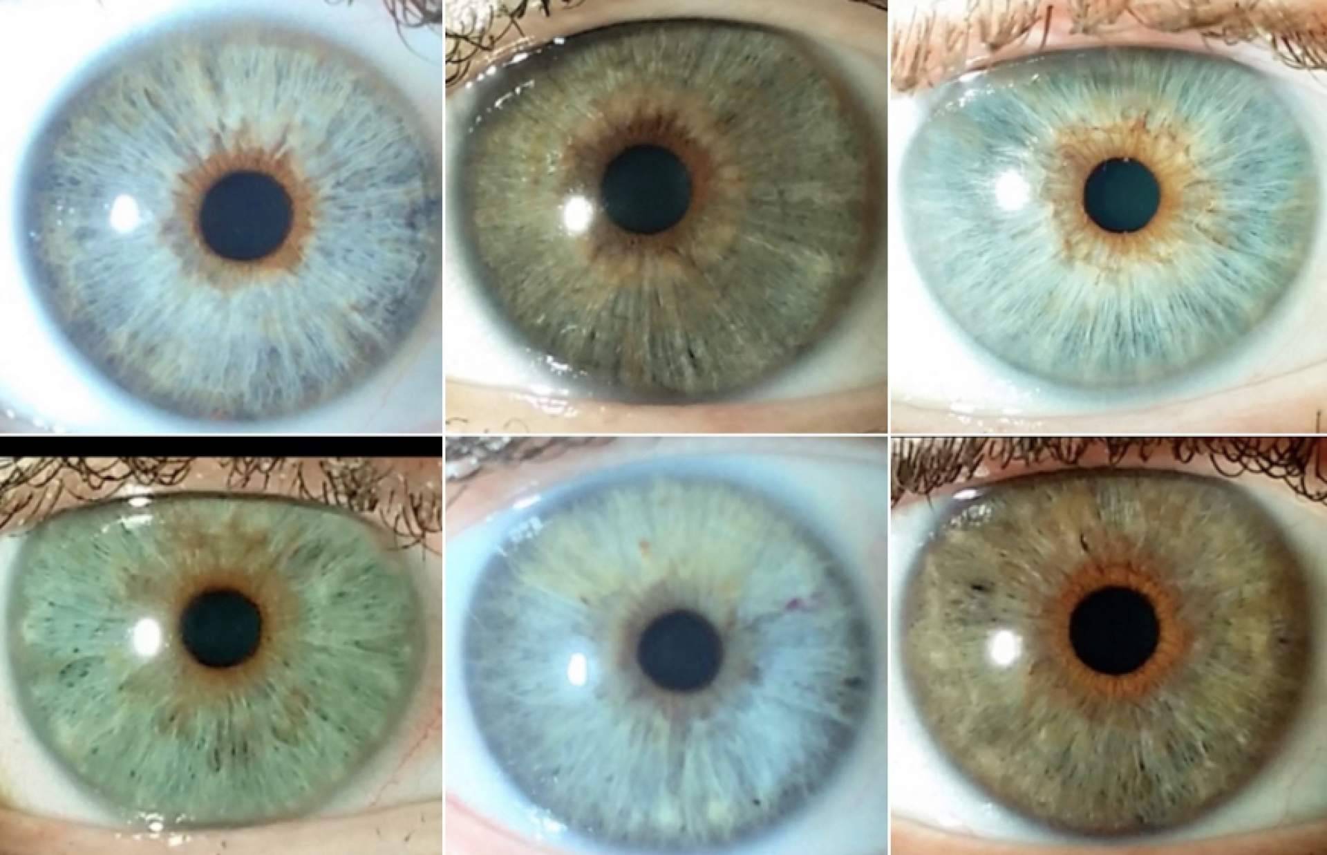 Cambiar el color de los ojos de forma segura, con Clínica Eyecos