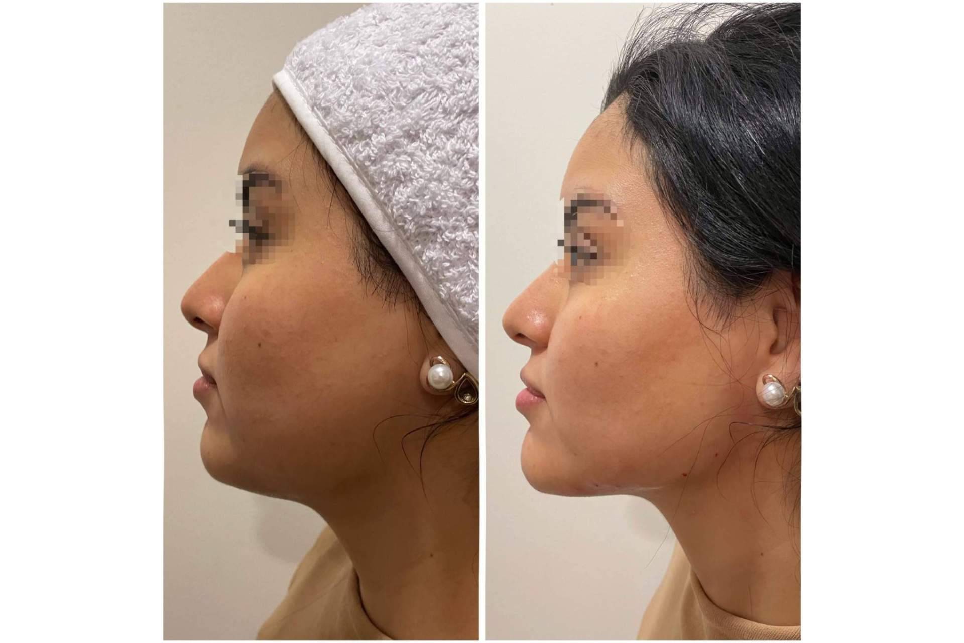 Dónde y por qué realizarse una marcación mandibular, con Cecilia Arthur