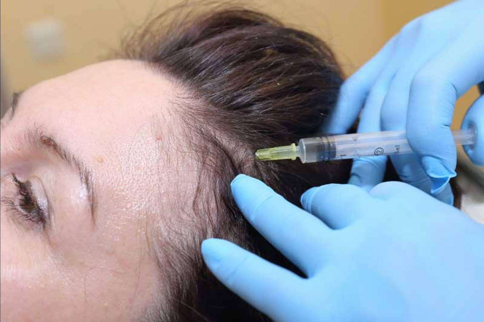 Cuáles son las ventajas de realizarse un tratamiento de mesoterapia capilar de IMD para recuperar las condiciones óptimas del cabello