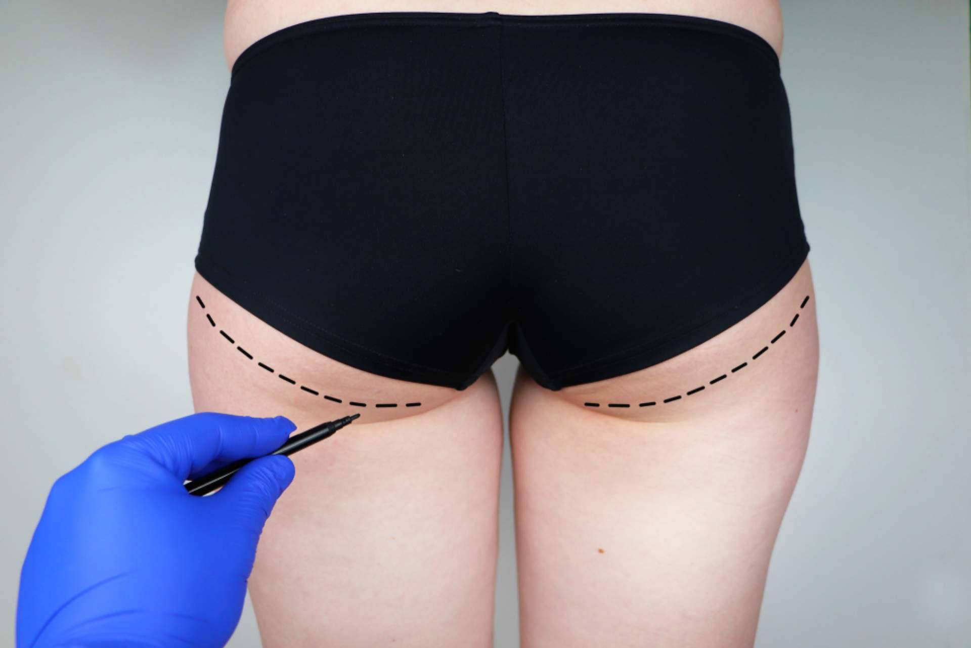 Técnicas avanzadas de gluteoplastia en Canarias, con el Dr. Julián Castillo