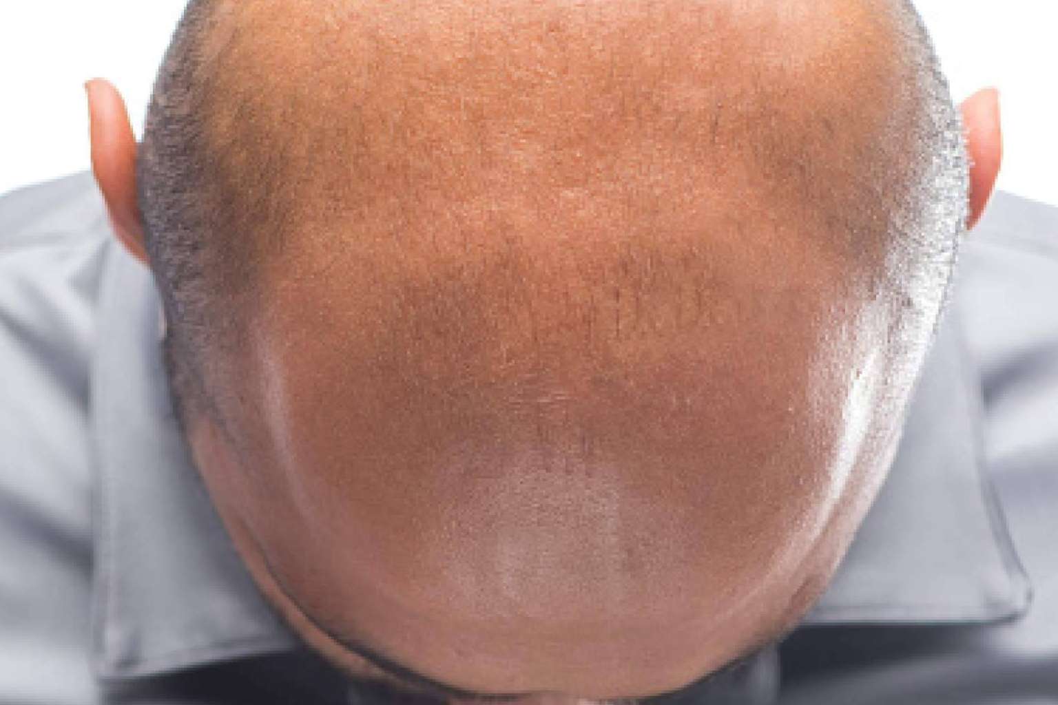 Los beneficios de la micropigmentación capilar, por Dermopigmentación Clínica
