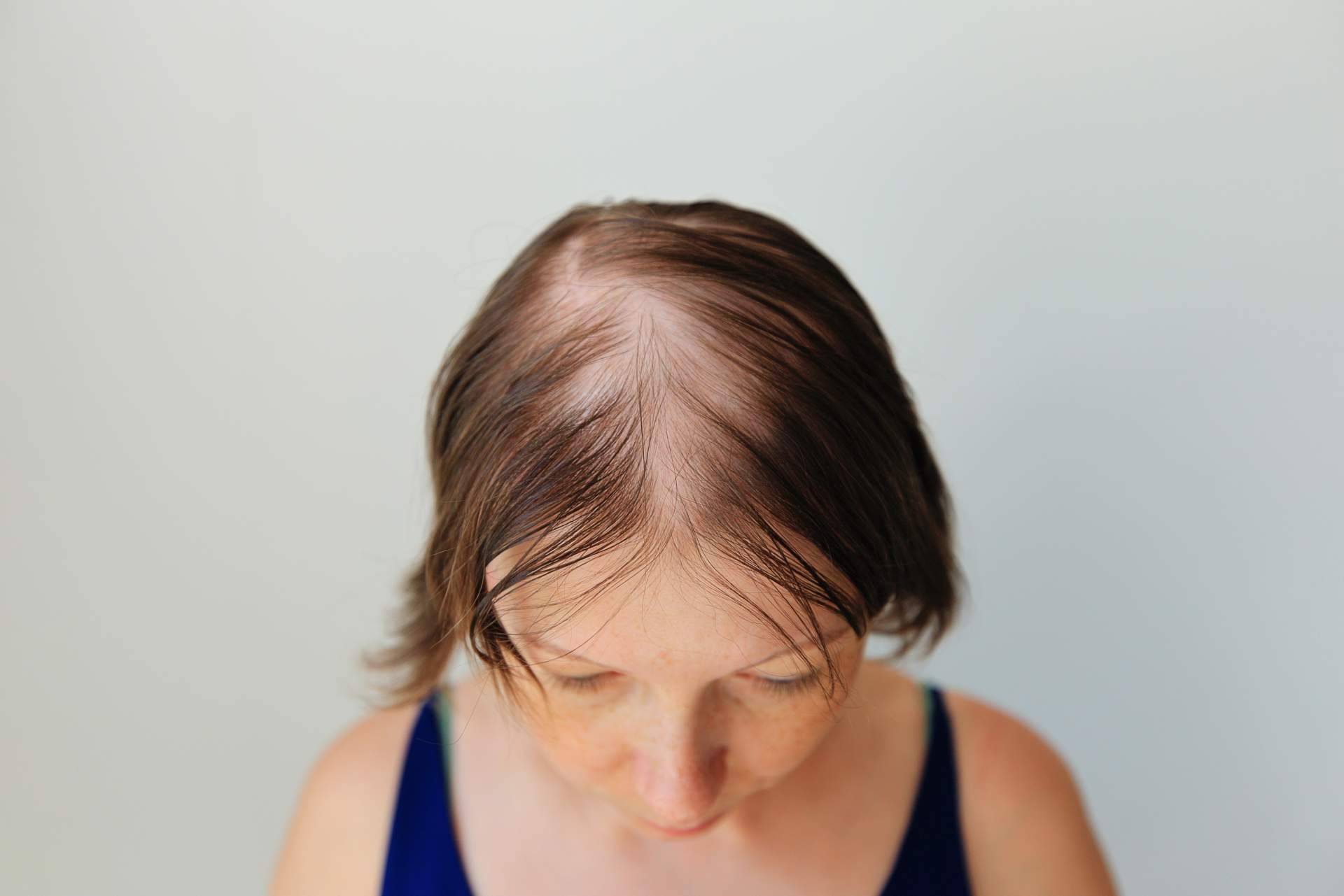 ¿Cómo detectar la alopecia femenina y qué tratamientos son los adecuados?