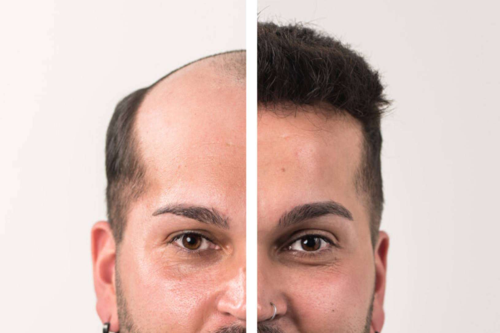 Las prótesis capilares para hombre, un mercado en auge, de la mano de Hair Inspira