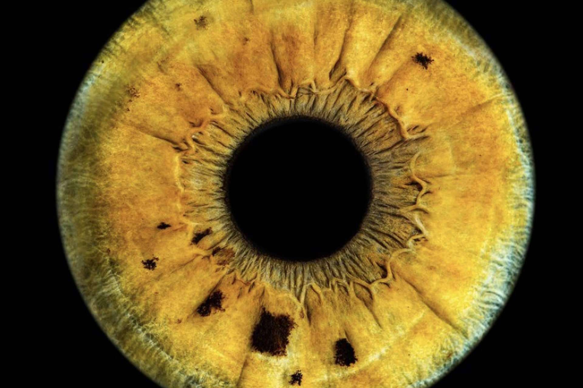 Perfil psicológico sano de los pacientes que realizan láser de cambio de color de ojos