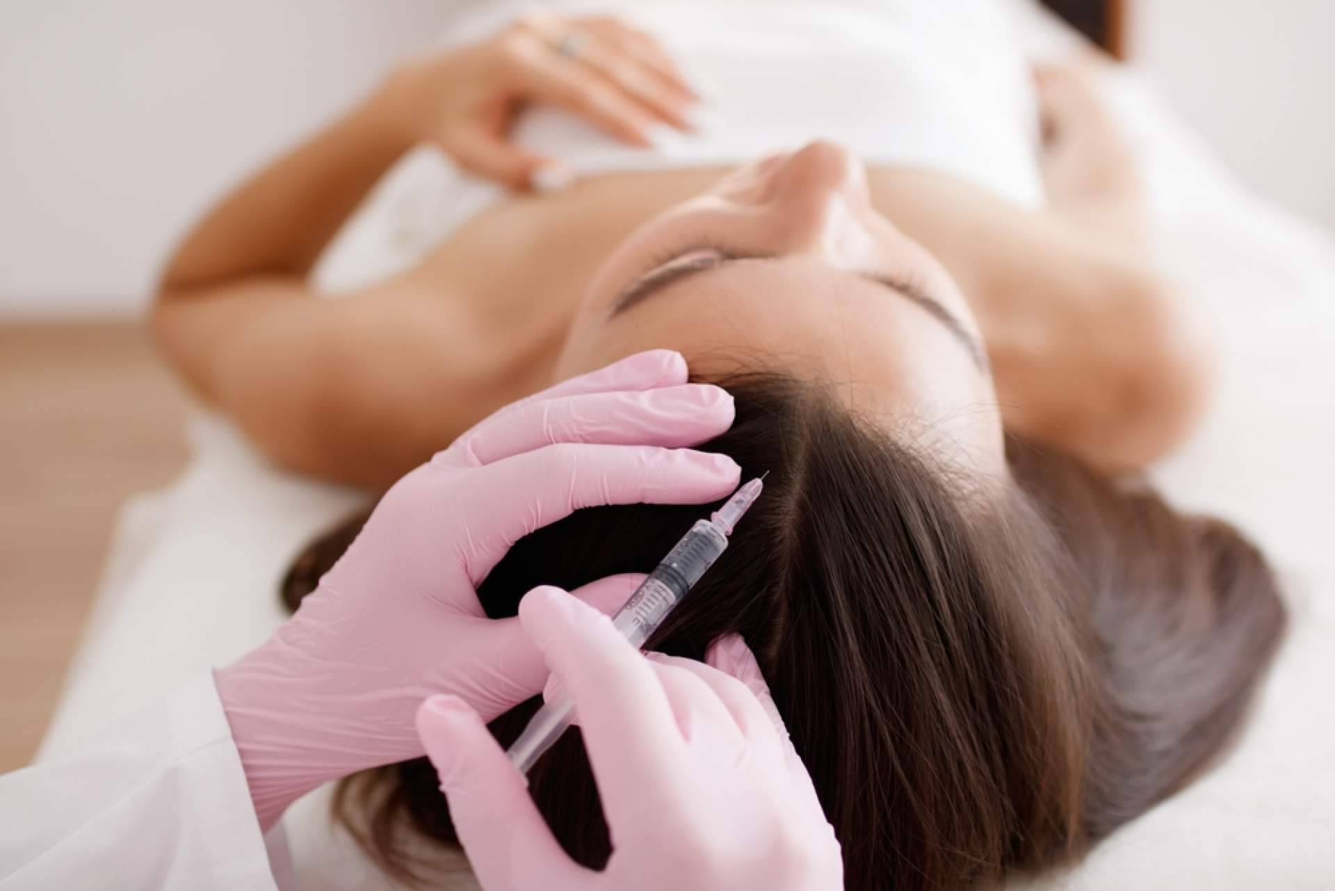 Mesoterapia capilar, una terapia sin cirugía que ayuda a combatir la pérdida del cabello