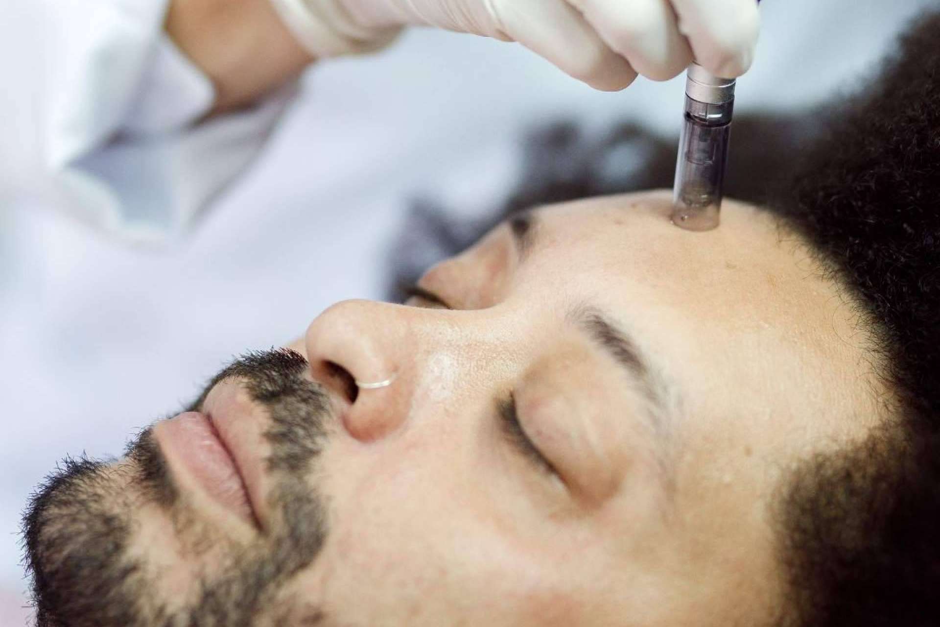 Malecare informa sobre el microneedling facial y capilar