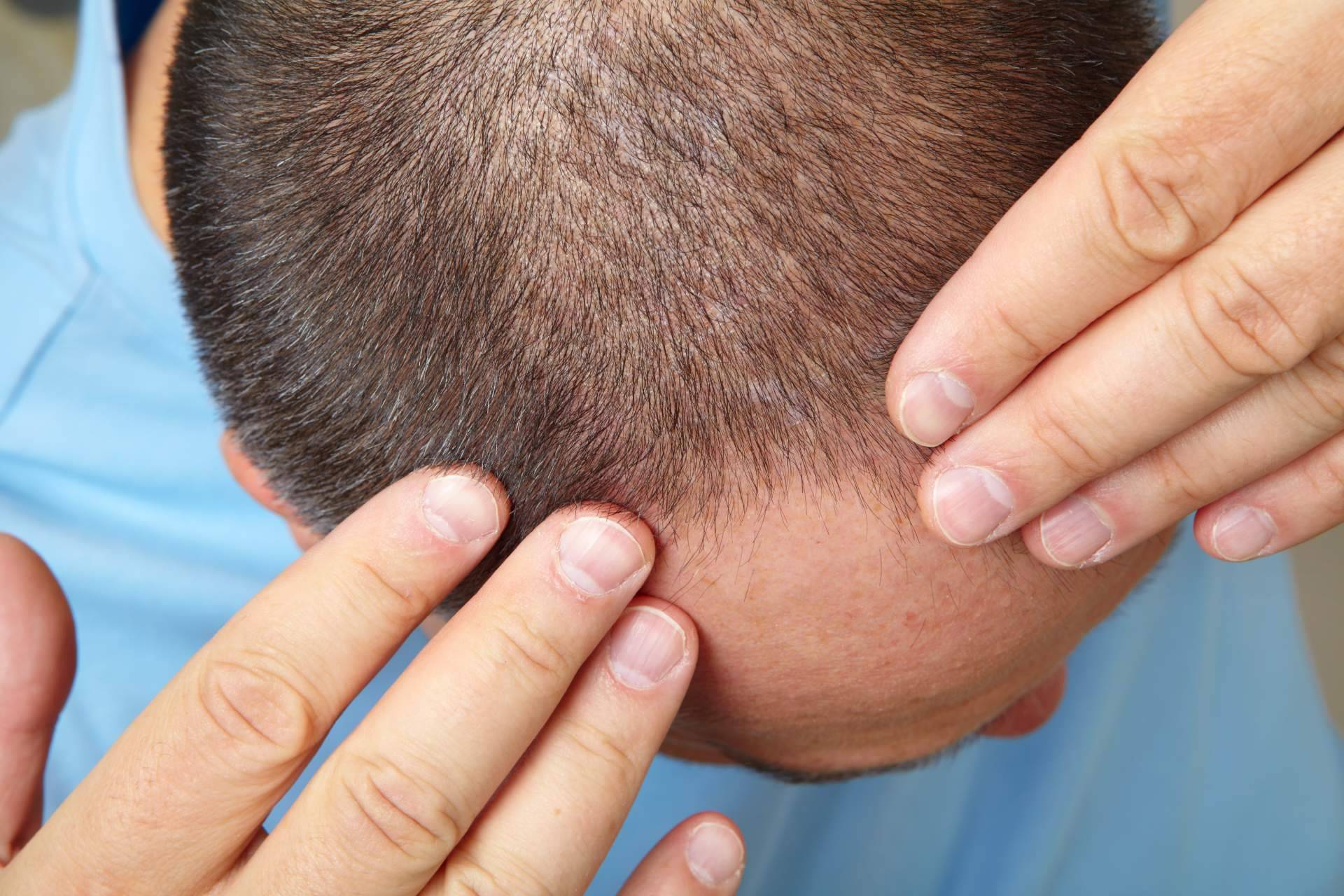 MC360 explica cuánto tarda en crecer el pelo después de un injerto capilar