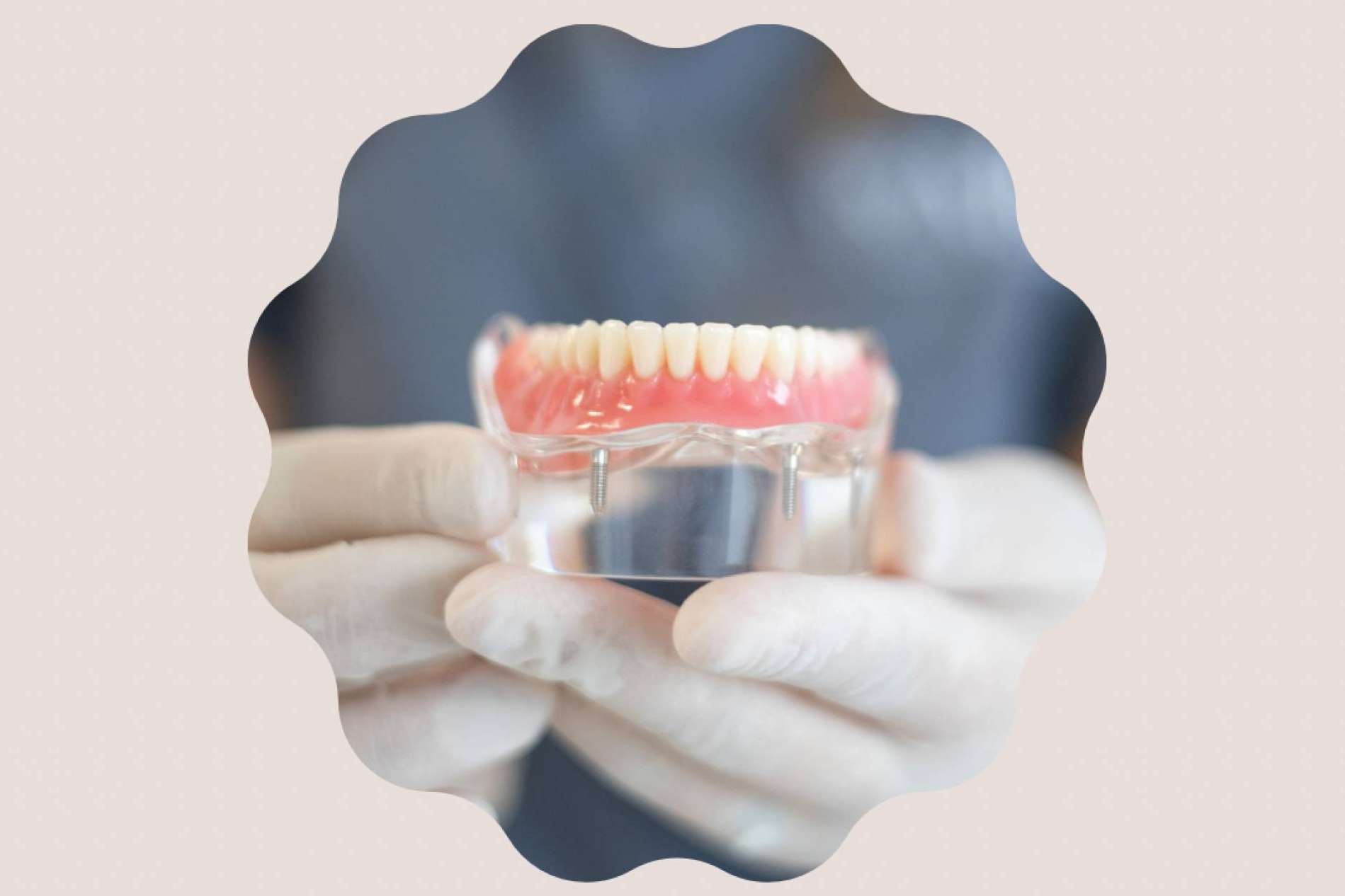 El tratamiento de implantología dental que ofrece Clínica MG Dental