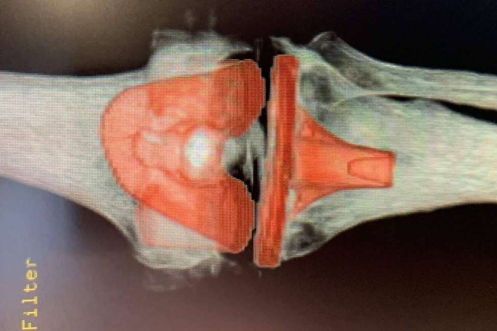 Los nuevos tratamientos para la artrosis y retrasar el envejecimiento del cuerpo