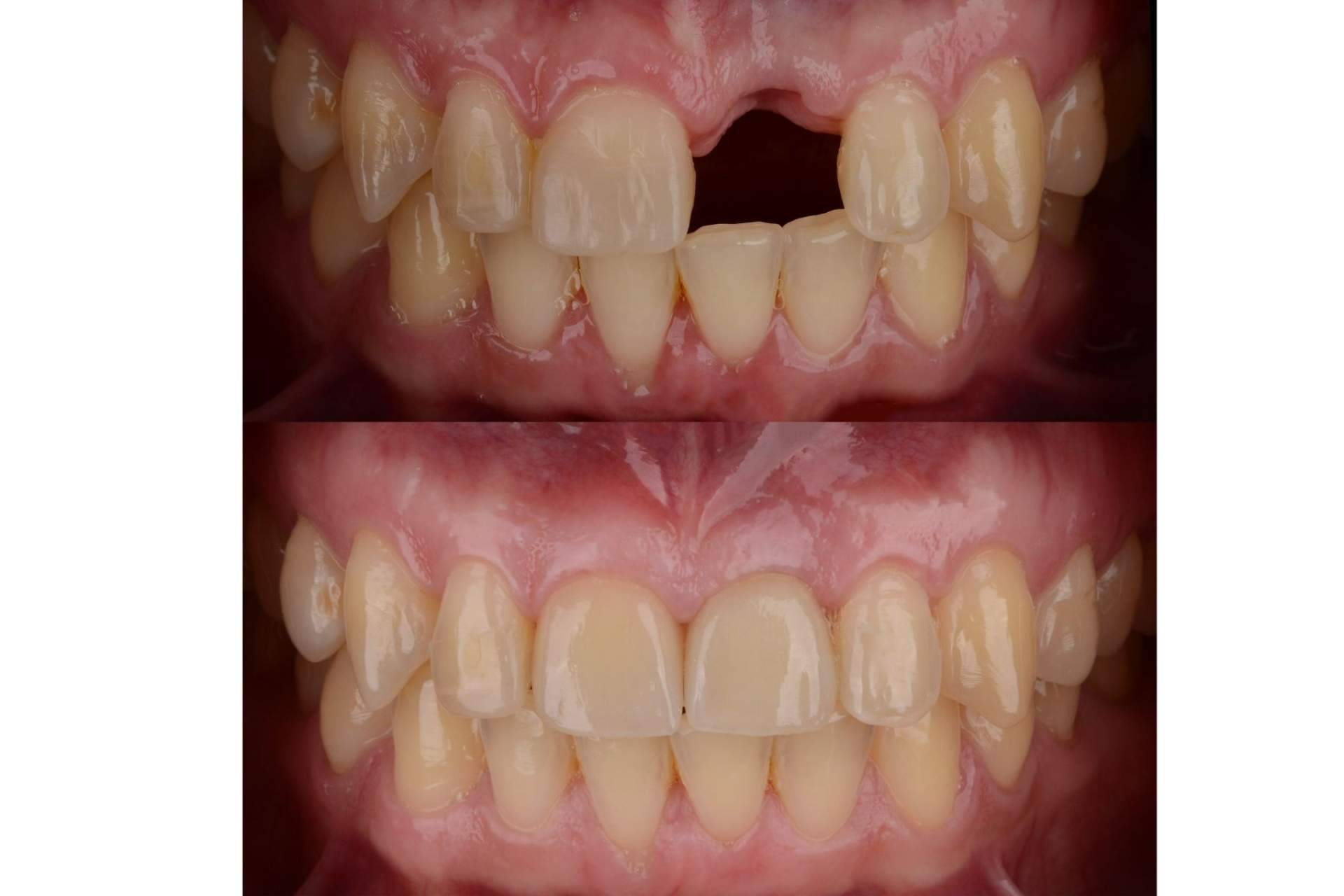 Los beneficios de un implante dental en DeltaDent