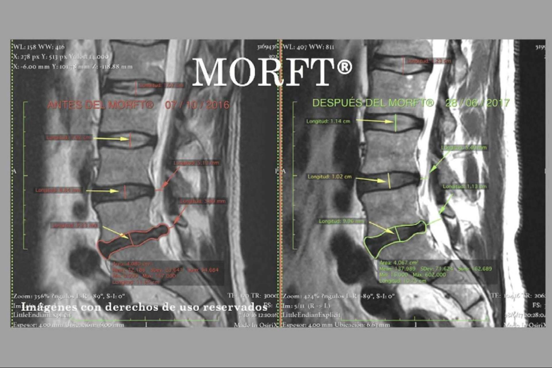 Con el método MORFT®, se puede hacer una regresión discal de las hernias