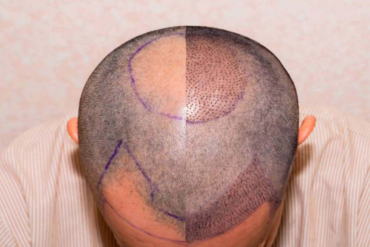 MC360 cuenta con expertos en injertos de pelo