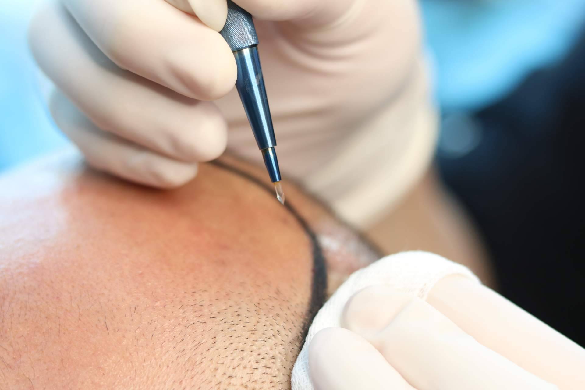 Capilar Innovation Clinic ofrece  la innovadora técnica de trasplante capilar masculino FUE Zafiro