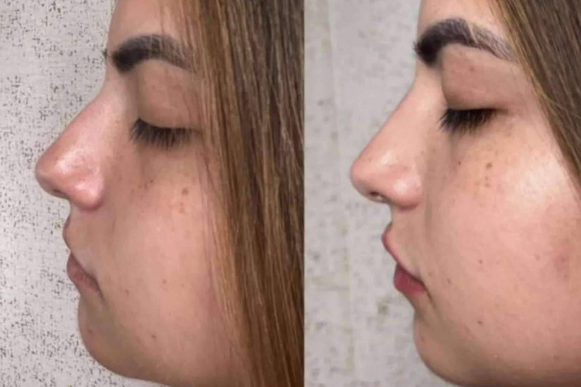 La clínica del Dr. Guidi cuenta con expertos en rinomodelación en Málaga