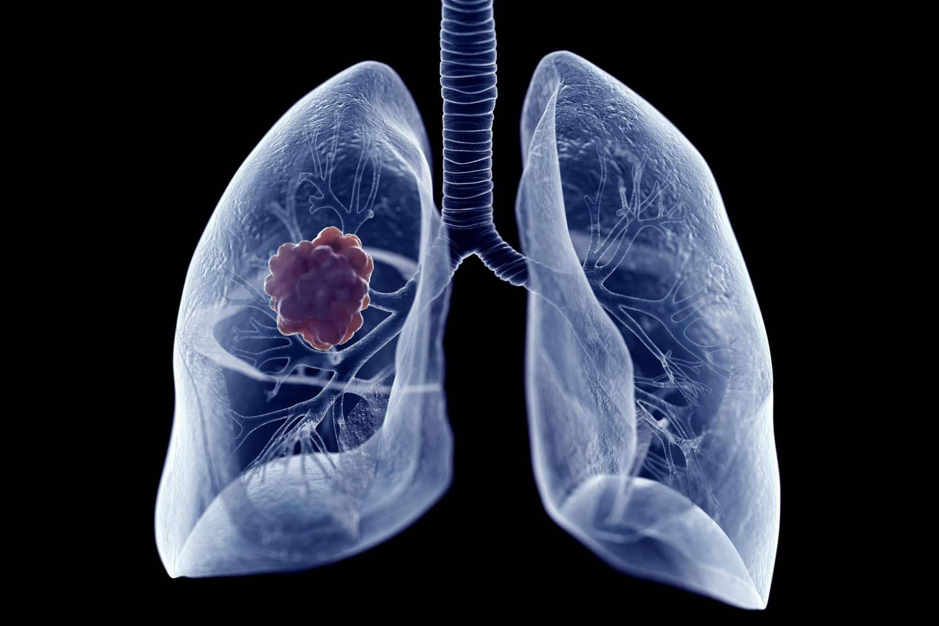 Oncothermia (Nanothermia), el tratamiento de cáncer de pulmón