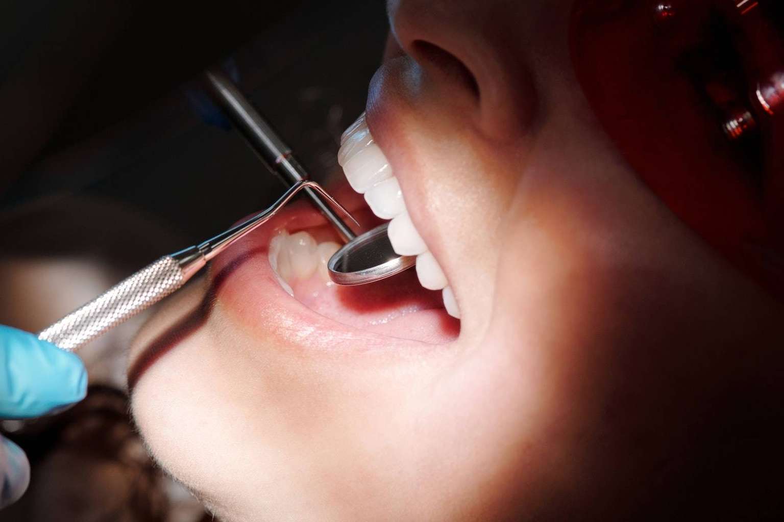 Qué son las carillas dentales, por Lola Escalante