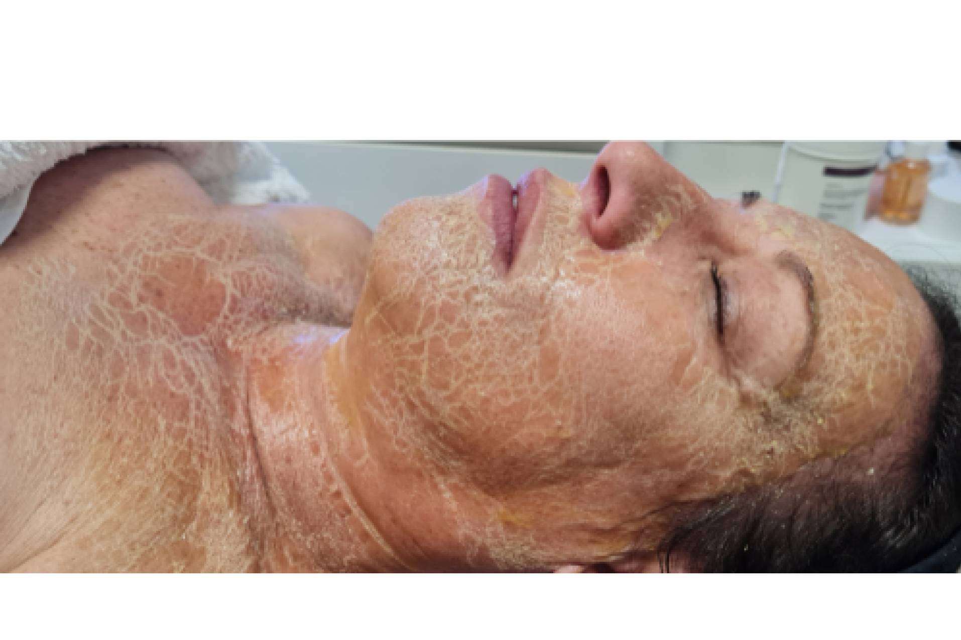 Revolución en los centros de estética con la mascarilla enzimática cosmedique