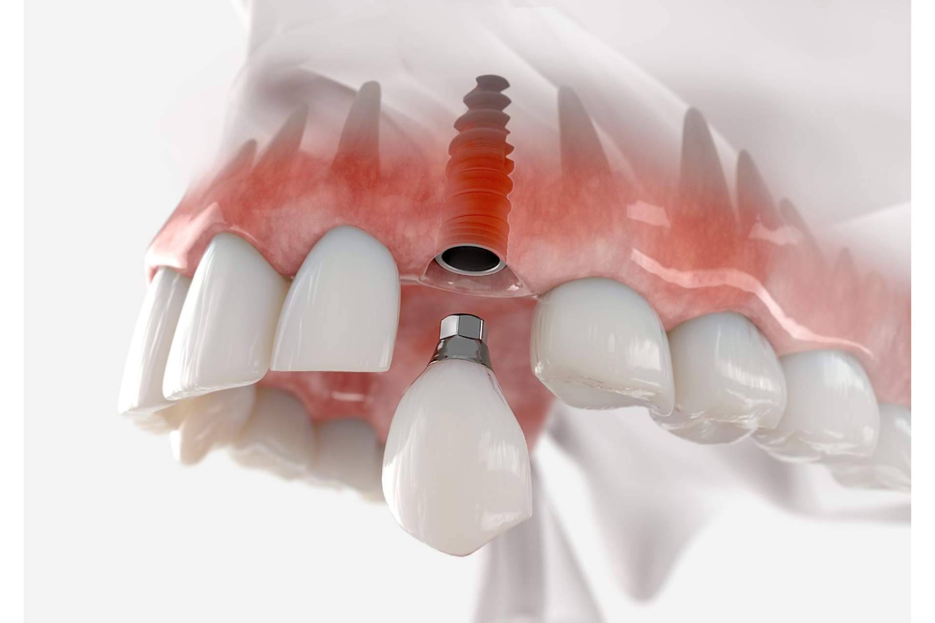 Servicios profesionales de implantología dental en Barcelona, con Clínica Dental Arai