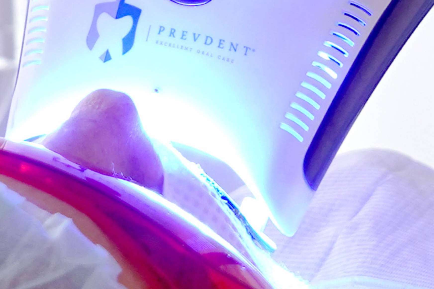 Blanqueamiento dental avanzado con luz LED para conseguir una apariencia radiante