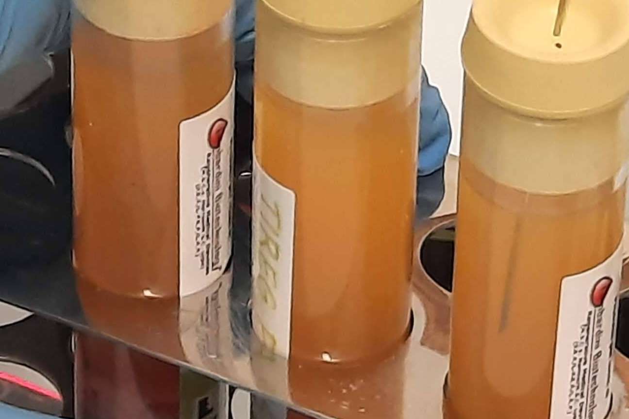 Tratar la artrosis de rodilla de manera eficaz sin cirugía a través de las infiltraciones de plasma rico en plaquetas y células madre