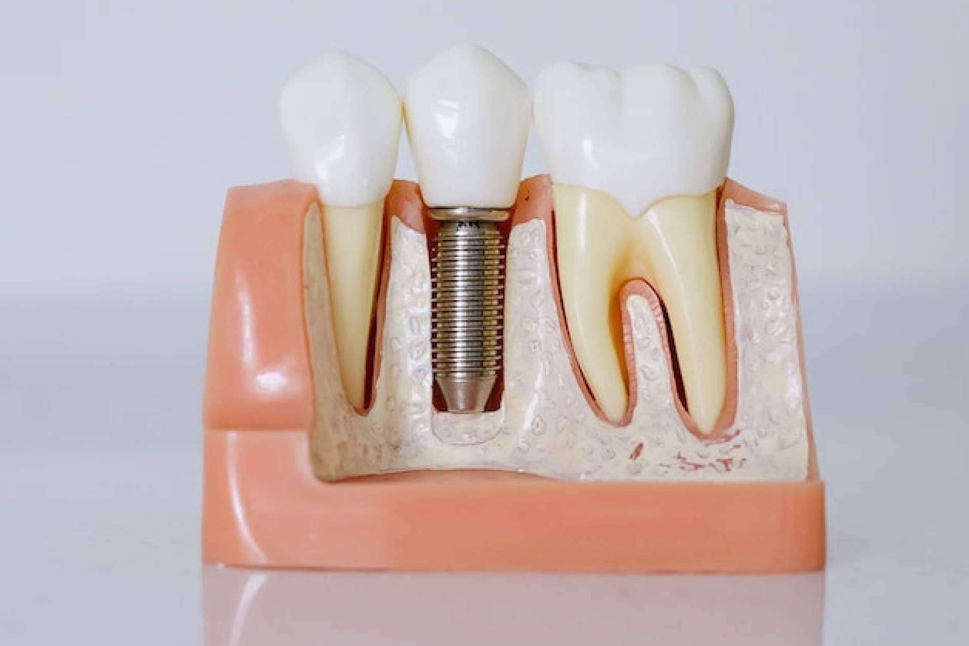 El estándar de calidad en implantes dentales de Denty Dent en Madrid