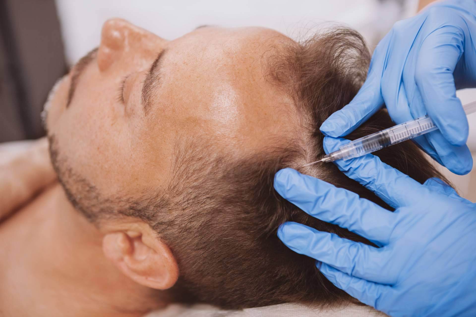 Tratamiento de la alopecia androgenética con exosomas, un método innovador que llega de la mano de Alluring Clinic