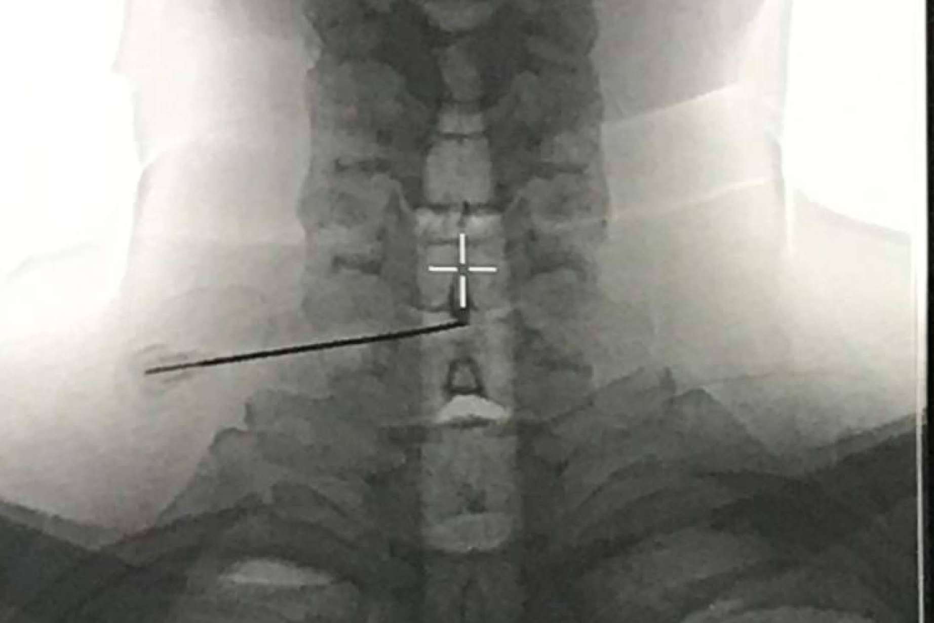 Ozonoterapia para hernia discal; el resultado se mantuvo 10 años después de la disolisis en el 88% de los casos
