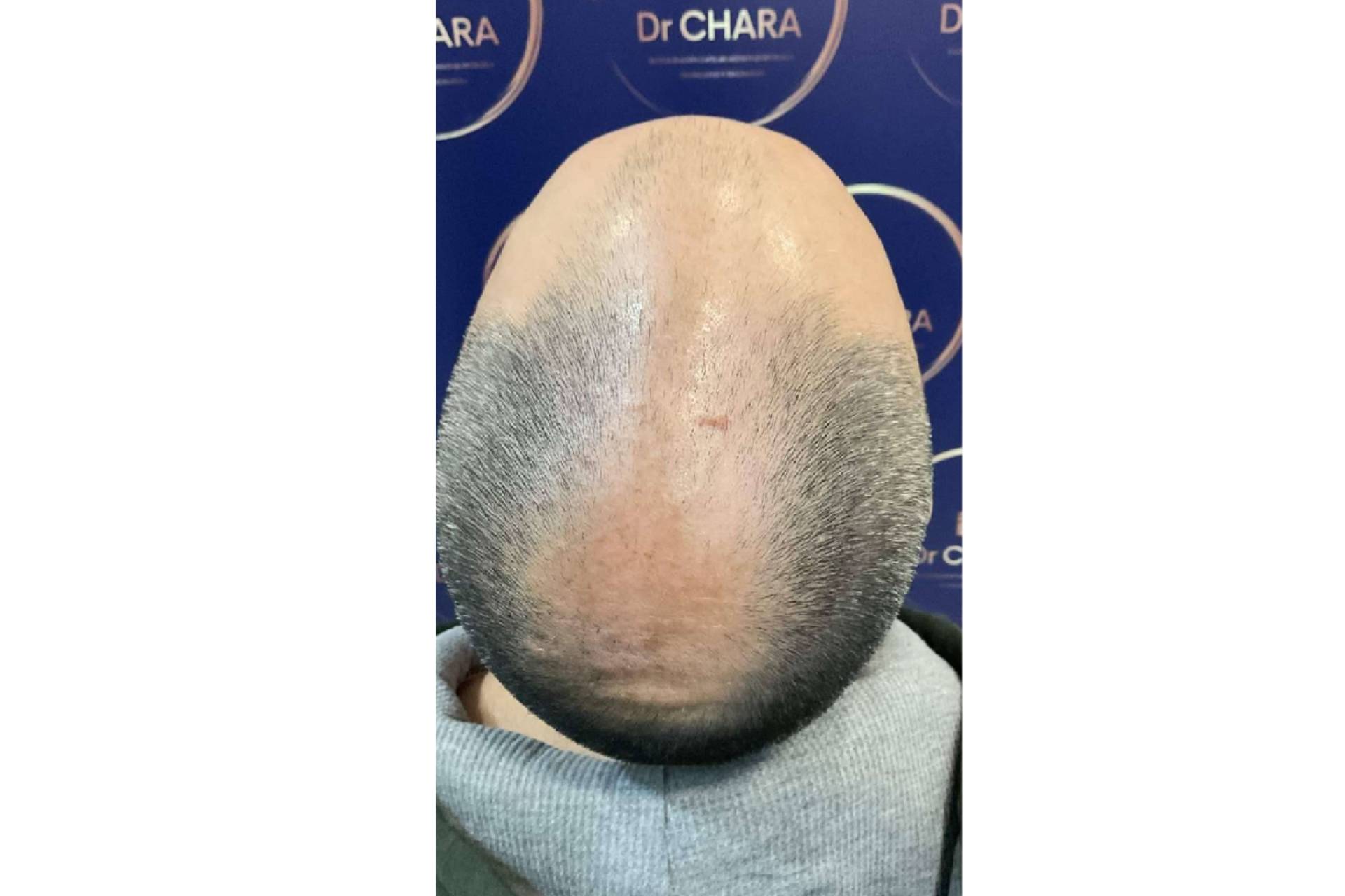 Chara Capilar en Barcelona ofrece los tratamientos más innovadores para la alopecia