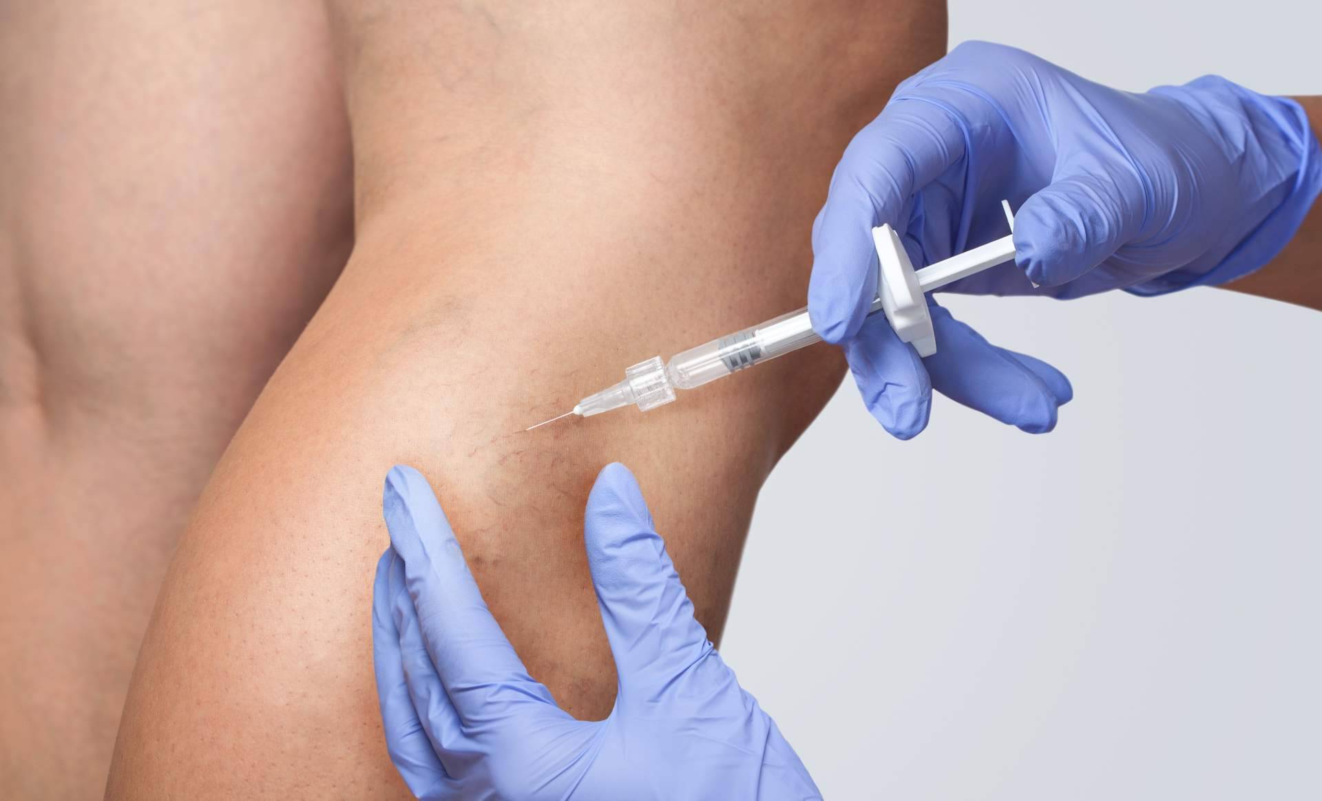 El Centro Estética El Pilar elimina las varices de las piernas en Madrid
