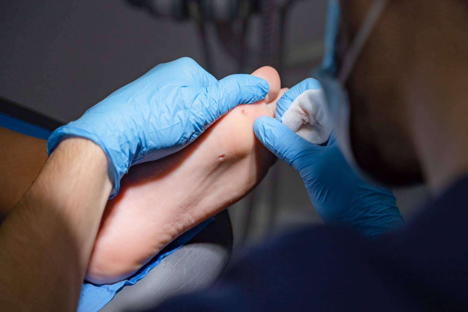 Cómo tratar los papilomas en los pies durante el verano