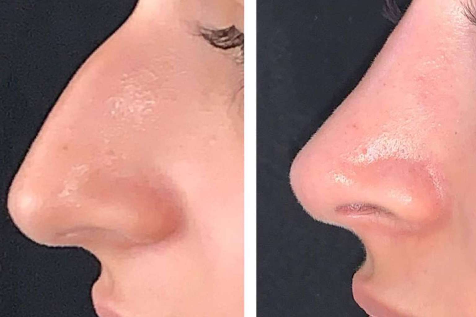 Clínica Menorca, centro especializado en rinoplastia ultrasónica en Madrid