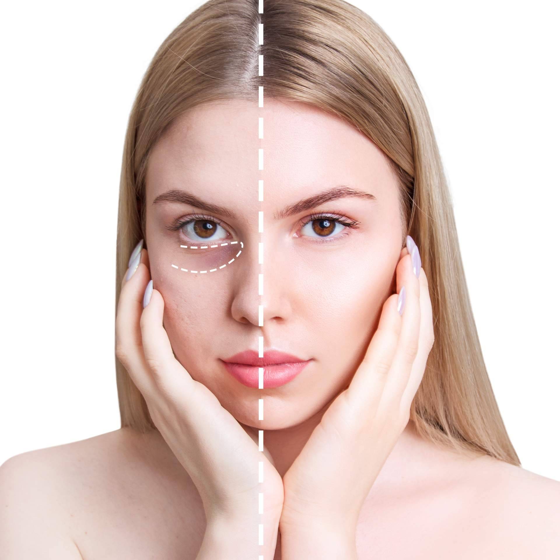 Corrección de las ojeras en Centro Estética El Pilar
