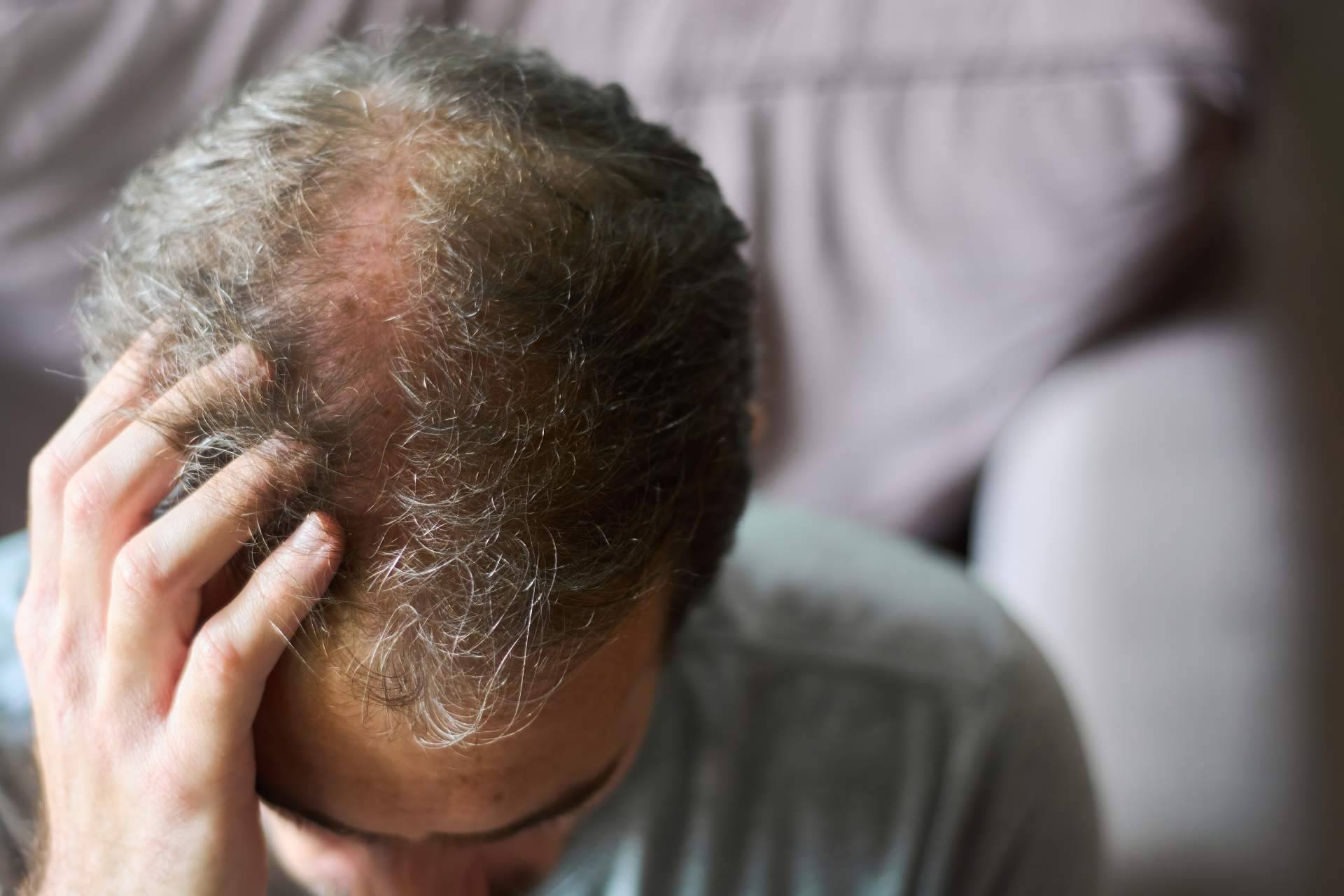 Alopecía androgénica; cómo afecta la caída del cabello a hombres y mujeres, por el Institut Mèdic DaVinci