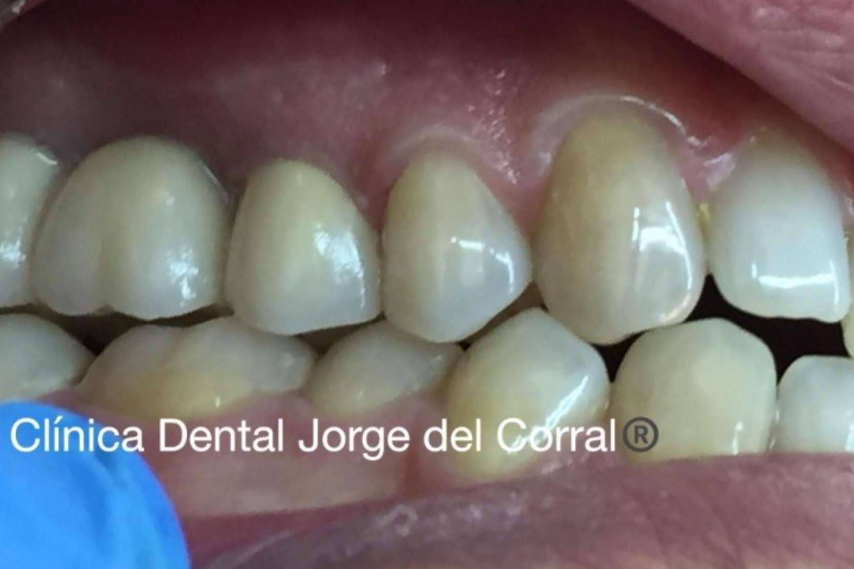 Prótesis fija estética de zirconio; la apuesta de Clínica Dental Jorge del Corral por la calidad y la estética dental