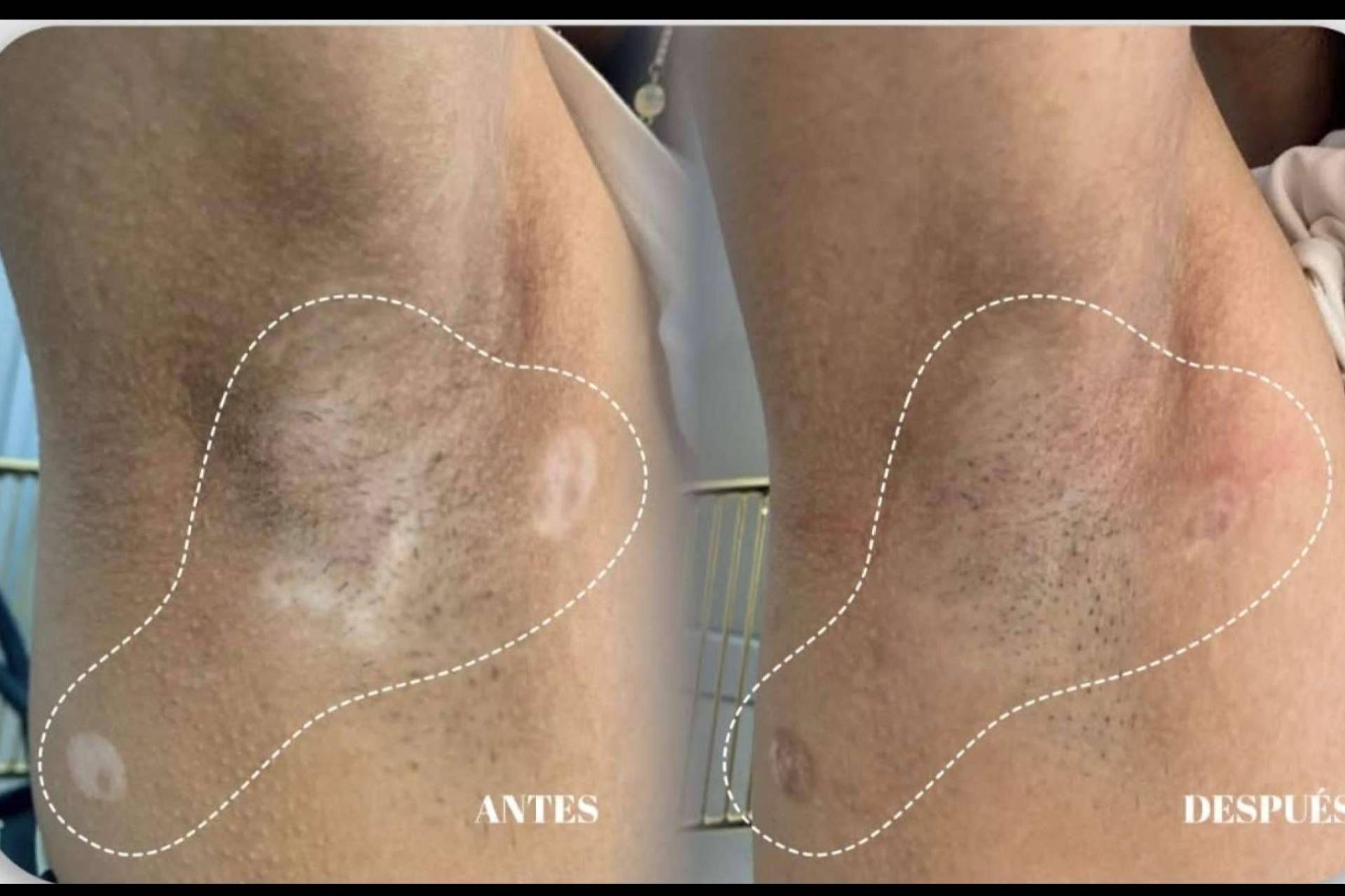 Clínica God Bless fortalece su especialización en vitiligo con la terapia combinada de la Dra. Janeth Arévalo