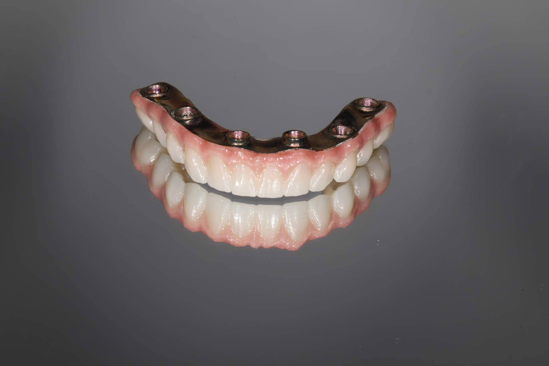 Implantes dentales; qué diferencia un tratamiento duradero de uno que puede fallar